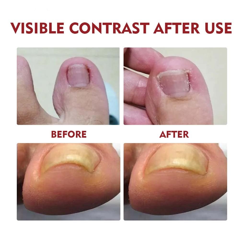Relief Nail Oil – Extra Strength Care for Discolored & Damaged Nails - BUY 1 GET 1 FREE