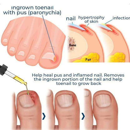 Relief Nail Oil – Extra Strength Care for Discolored & Damaged Nails - BUY 1 GET 1 FREE